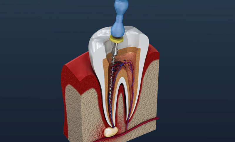 Endodoncia