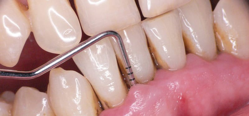 Periodoncia