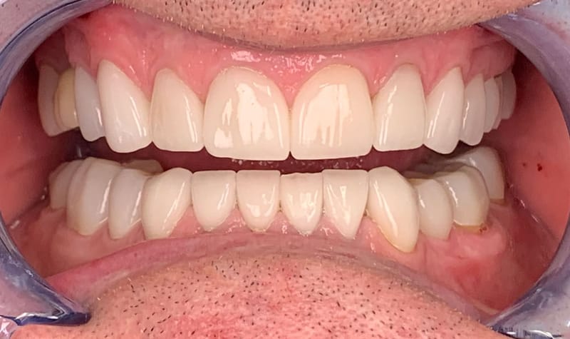 How Dentists Provide A Harmonious Smile With Dental Bonding And Dental Implant?