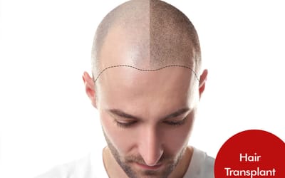 Best Hair Transplant in Chandigarh image