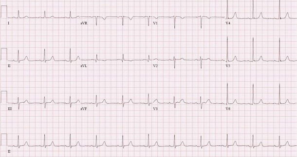 ECG