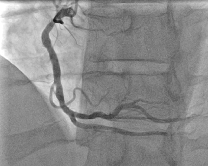 Angiography, angioplasty and stenting
