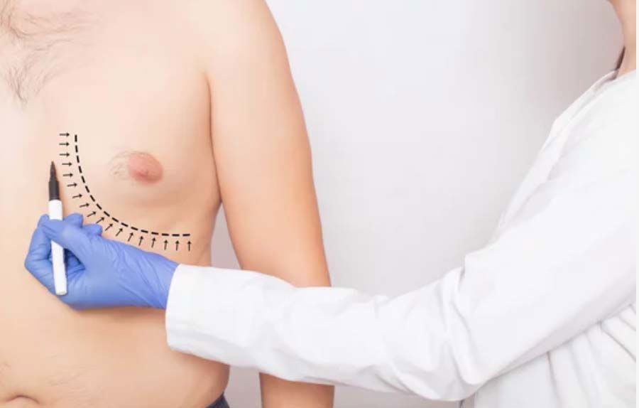 Male Breast Reduction