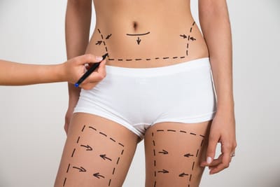 Tummy Tuck[Abdominoplasty]