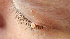 WARTS REMOVAL