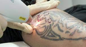 LASER TREATMENT