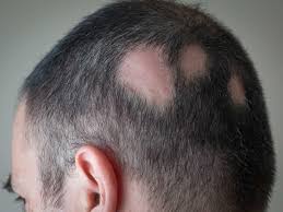HAIR LOSS TREATMENT 
