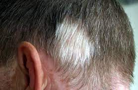HAIR LOSS TREATMENT 