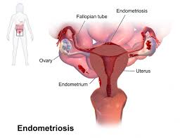 Womb Cleaning