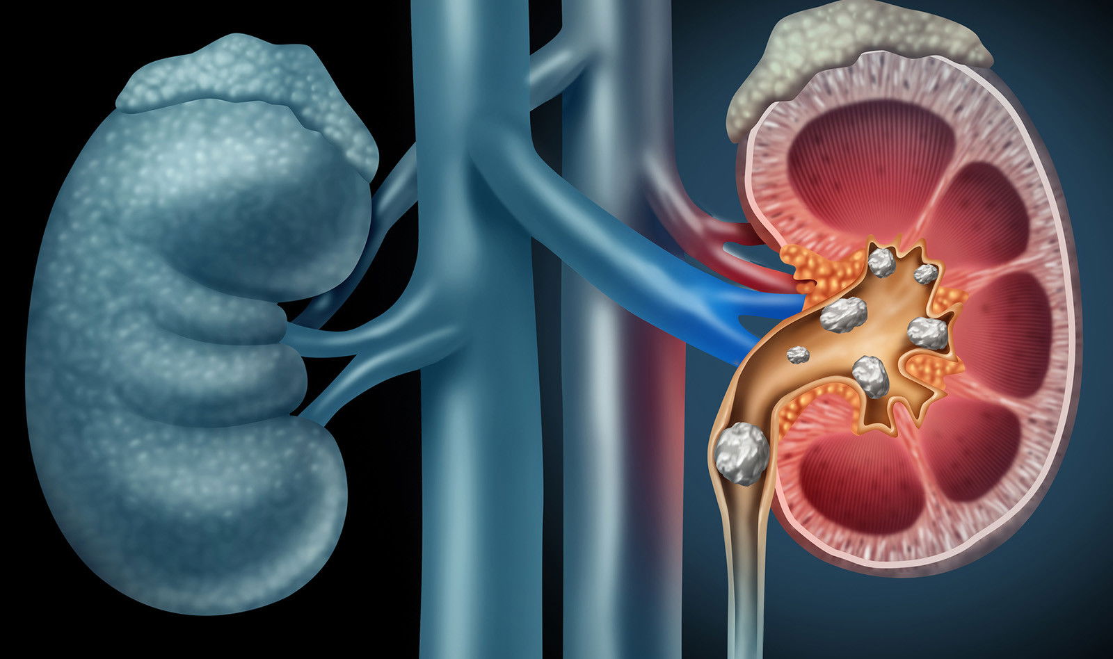 Kidneys Check Up... Renal Ultrasound