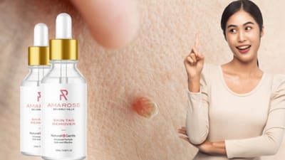 Amarose Skin Tag Remover Reviews: Best Skin Tag Removers You Can Use Easily At Home! image