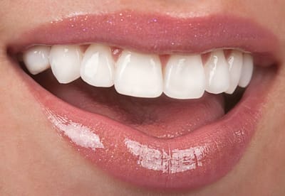 Qu'est ce que des Facettes dentaires VENEER?