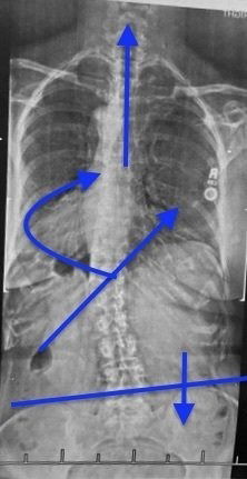 The SEAS (Scientific Exercise Approach to Scoliosis) Method