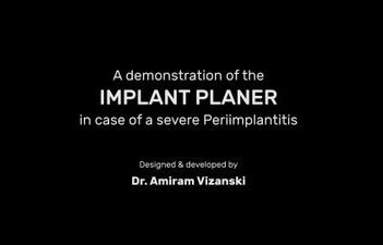 This video describes severe peri implantitis treatment