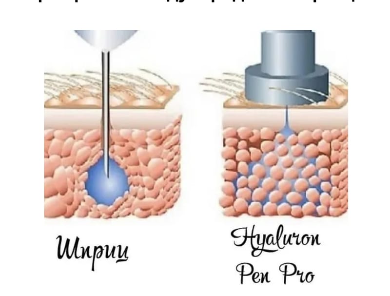 Увеличение губ (гиалурон пен) 2 модели