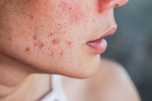 Acne Solution Treatment