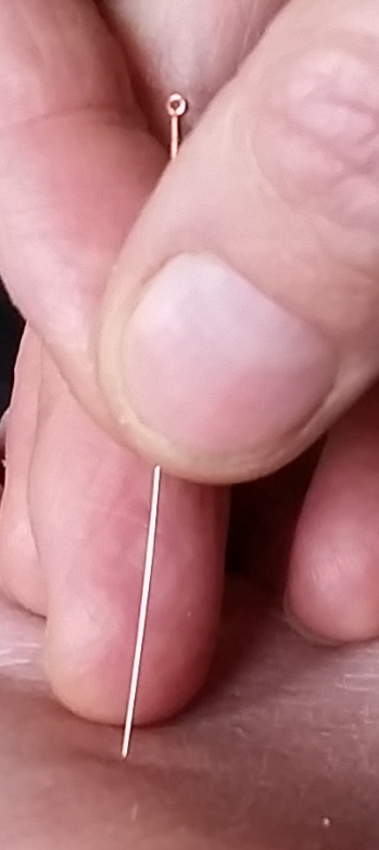 Wat is acupunctuur? image