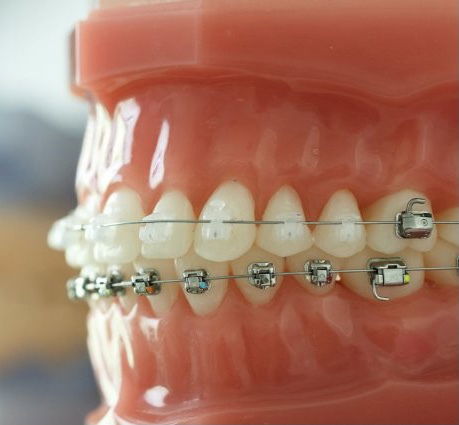 ORTHODONTIC TREATMENT