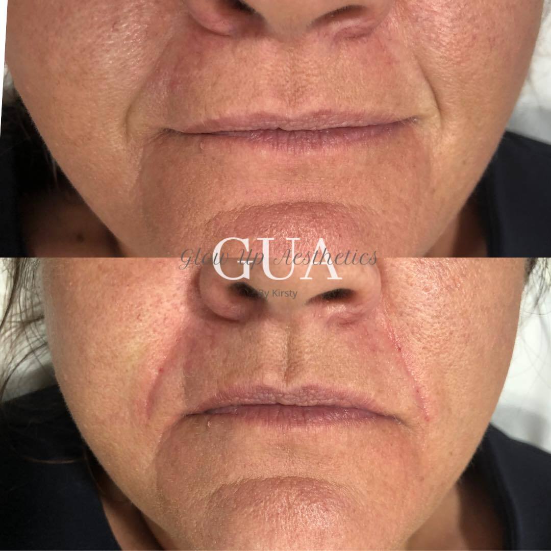 Nasolabial filler