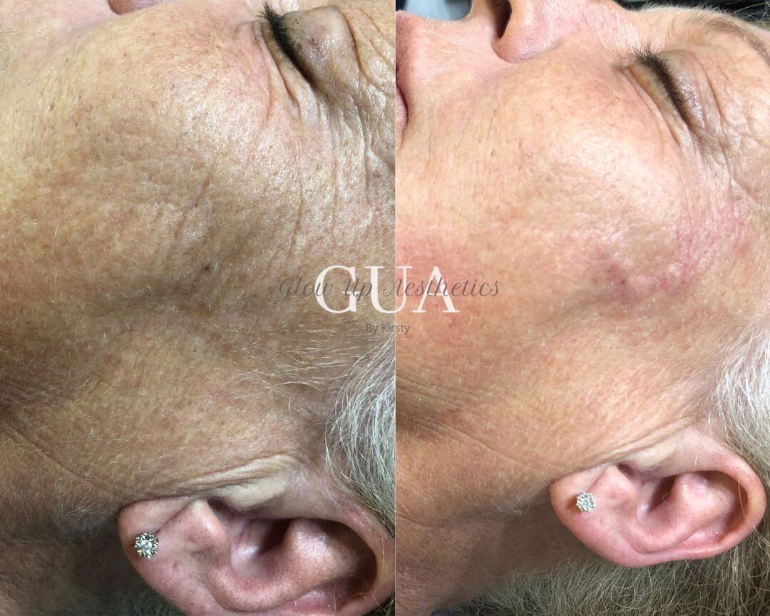 PRP injections
