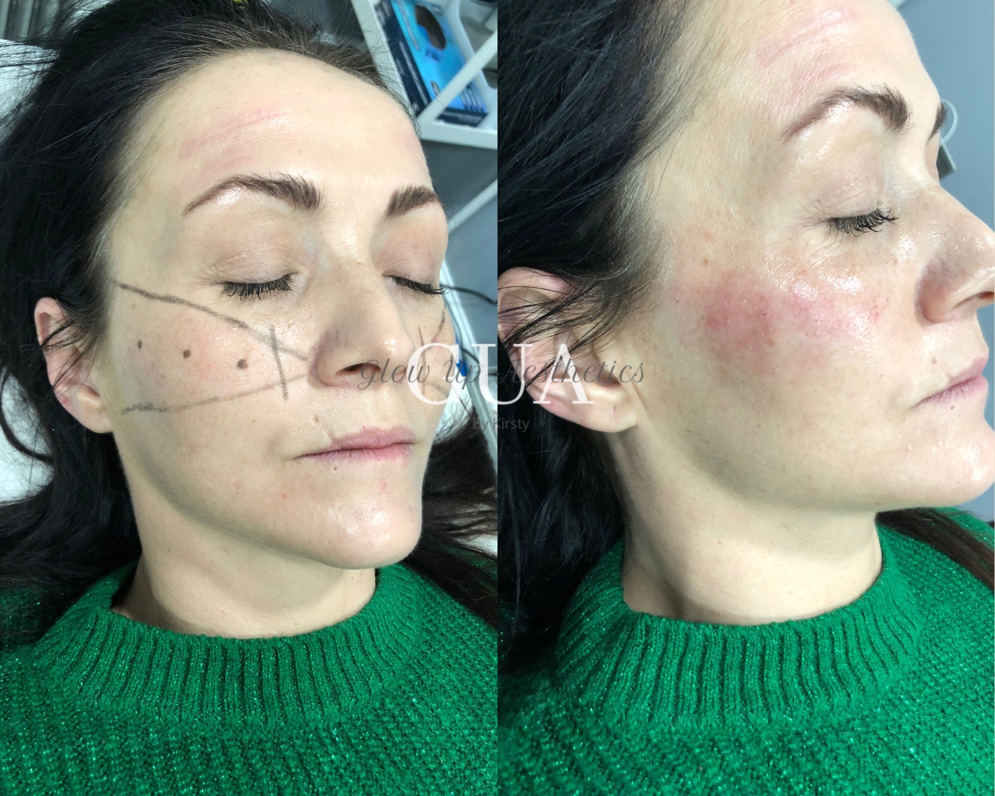 Cheek filler