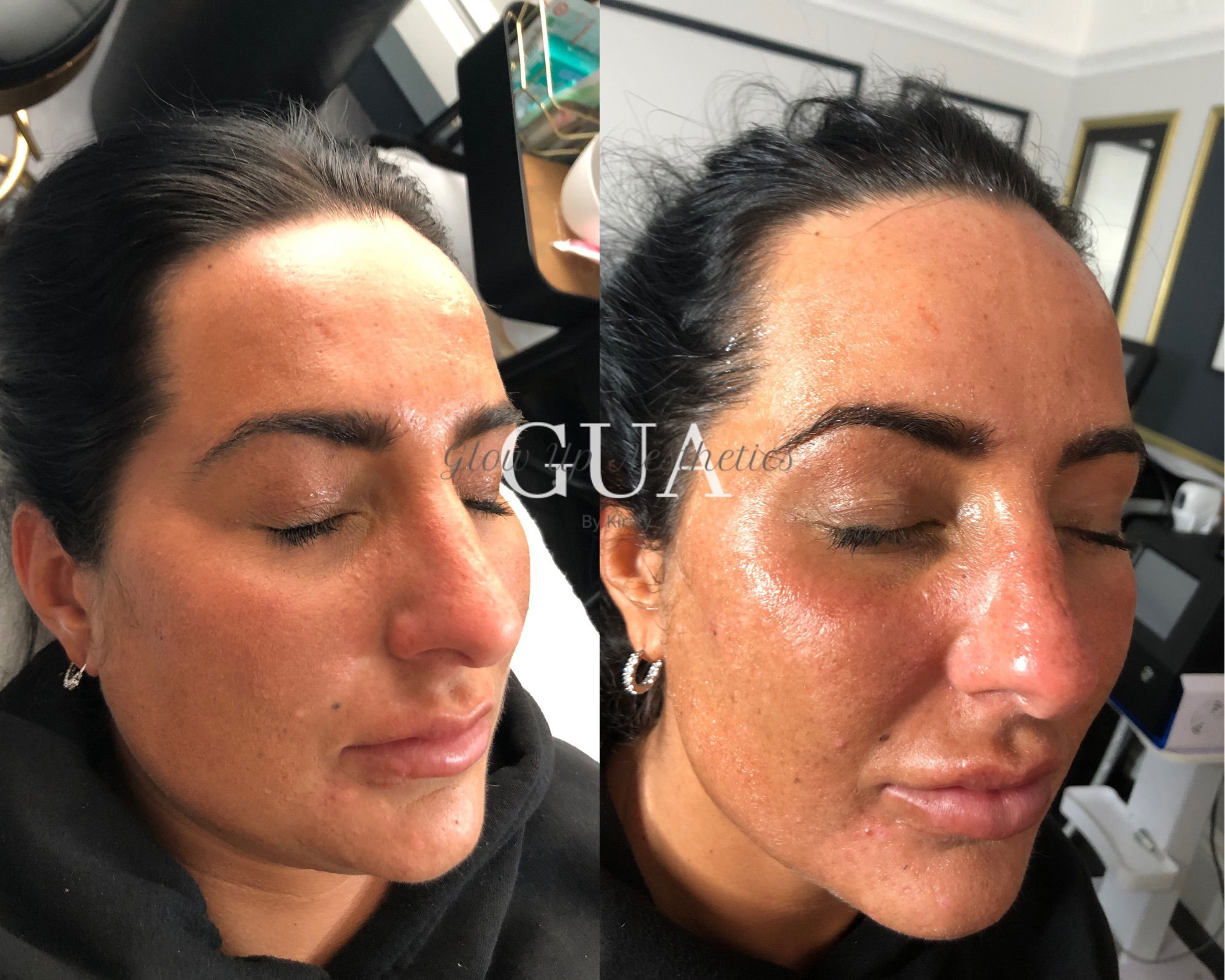 Hydrofacial