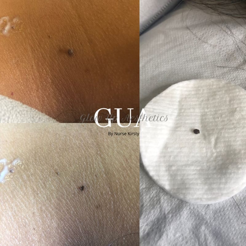 Skin tag removal