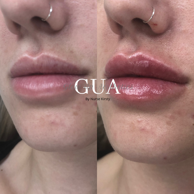 Lip augmentation