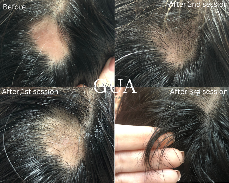 PRP Hair loss treatment