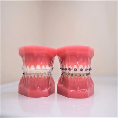 How To Select The Color Of Your Braces?