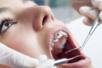 Preventing and Treating Tooth Decay in Kids.