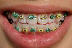 What Do Power Chain Braces Do?