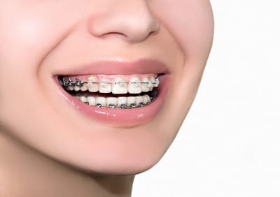Does Braces Fix An Overbite?