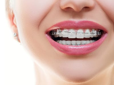 How Long Does It Take For Braces On The Bottom Teeth To Start Working?