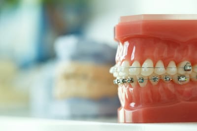 Can Lingual Braces Miami Fix An Overbite?