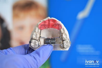 How does Teeth Straightening Work to Improve the Alignment of Teeth?
