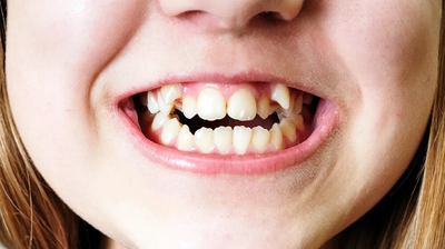 How Can Crooked Teeth Impact A Person's Oral Health and Overall Well-Being?