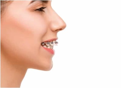 What Impacts The Price Of Overbite Braces?