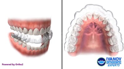 How do Clear Aligners Like Invisalign Work as an Alternative to Braces?