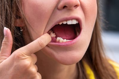 How long does it Typically Take for A Wisdom Tooth Hole to Heal?