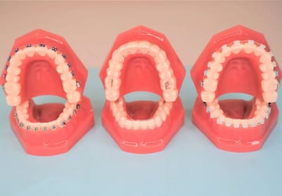 What is A Braces Power Chain, and How Does it Work?