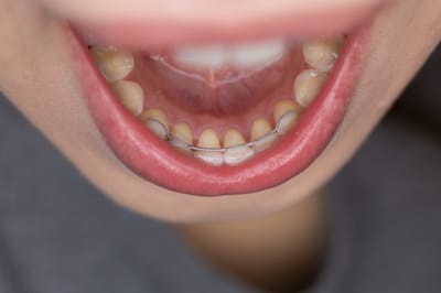 How does A Permanent Retainer Help Maintain the Alignment of the Teeth?