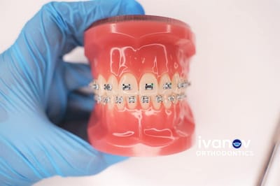 What is the Impact of Power Chain Colors on the Appearance of Braces?