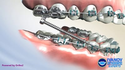 How long should a patient typically wear the Forsus appliance each day?