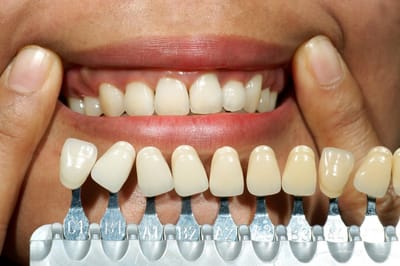 What Care is Needed After Dental Bonding in Miami?