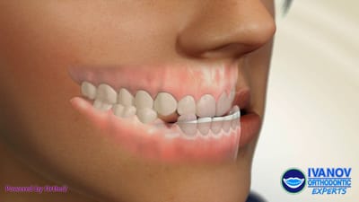 What are Underbite Braces?