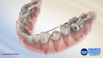 How Long is a Lower Lingual Retainer Typically Worn?