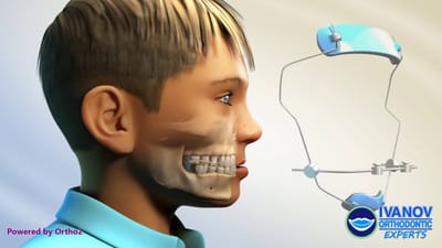 What is Reverse Pull Headgear and How Does it Differ From Traditional Headgear in Orthodontics?