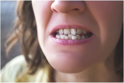 What Orthodontic Issues Can Arise From Untreated Crooked Teeth, And Why Is It Important To Address Them Promptly?