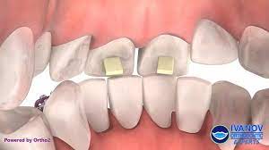 What Are Bite Turbos, And How Do They Function In Orthodontic Treatment?